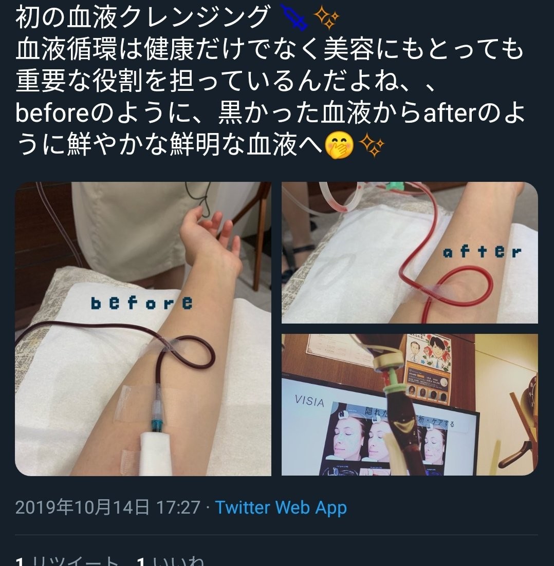 [Flame] Minami Takahashi and Hachu are “blood cleansing” suspicious beauty stemmer → Gase medical care that only bears the risk of infection and detection www